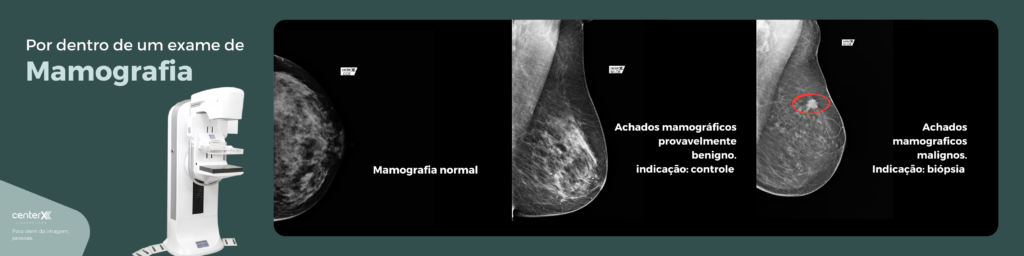 Exame de mamografia - achados
